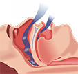 Apnea