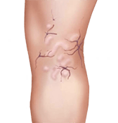 Trombosis